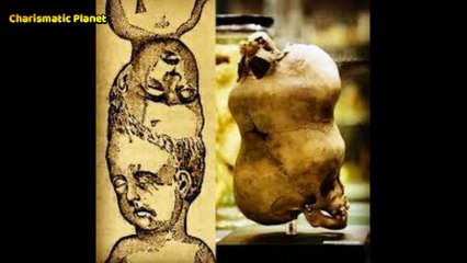 Craniopagus Parasiticus | The Story of the Two-Headed Boy of Bengal