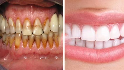 Gutkha Ke Dant Kaise Saaf Kare Jaate Hain, दांतो के काले धब्बे हटाने का घरेलू उपाय | Boldsky