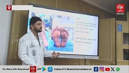 ಮಧುಮೇಹ ಪೀಡಿತನ ಕಾಲು ತುಂಡರಿಸದೇ ಯಶಸ್ವಿ ಚಿಕಿತ್ಸೆ ನೀಡಿದ ವೈದ್ಯರು: ನೂತನ ಐವಿಎಲ್ ತಂತ್ರಜ್ಞಾನ ಬಳಕೆ!