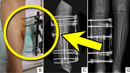 Metal Implant Side Effects: फ्रैक्चर होने पर प्लेट/स्क्रू/रोड लगाने के नुकसान, Metal Implant Allergy