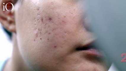 Troppo zucchero nel corpo? I segnali da non ignorare