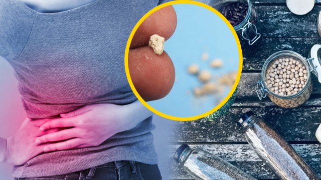 Kidney Stone Causes:किडनी स्टोन में क्या खाना चाहिए और क्या नहीं | Benefits In Hindi | Boldsky