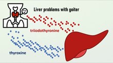 Liver problems with goiter
