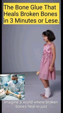 Unbelievable! Bone Glue That Repairs Broken Bones in Just 3 Minutes! #ViralHashtags:#BoneGlueMiracle#HealingInFlash#MedicalWonders#EngagementHashtags:#BoneHealthTips#MedicalInnovation#HealthTechNews