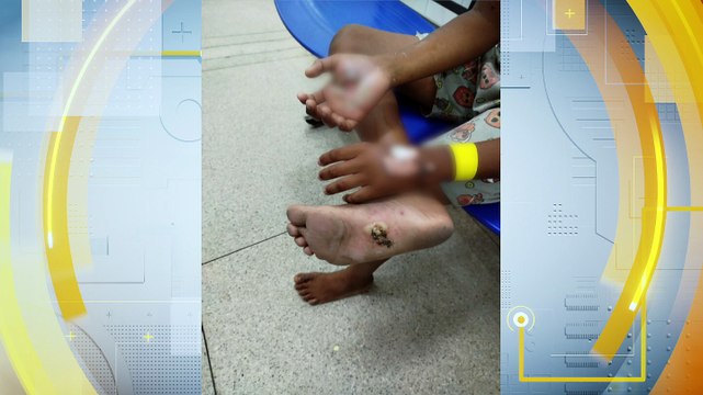 Caso Chocante de Abuso Infantil: Mãe Queima Filho por Pequeno Roubo em Prazeres - Como Identificar e Denunciar Maus Tratos a Crianças