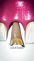 Bone Grafting Explained 🤔