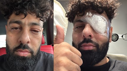 Rapper Badshah Eye Injury Photo Viral, आंख पर चोट लगने का Reason Reveal...| Boldsky