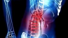 Benign Prostatic Hyperplasia (BPH)