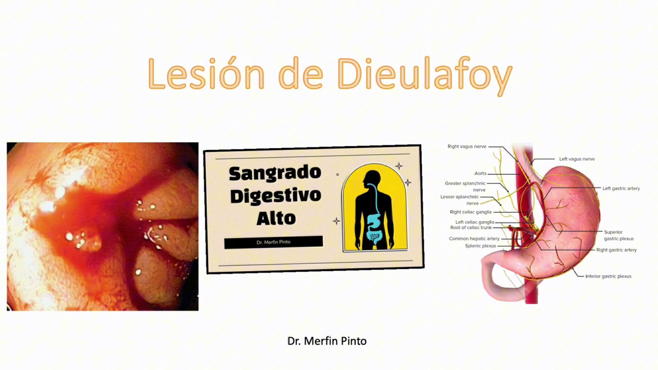 Lesión de Dieulafoy #elcuerpoymas #salud #medicina #Dieulafoy