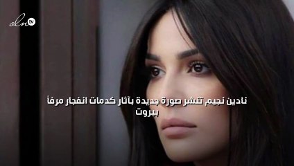 نادين نجيم تنشر صورة جديدة بآثار كدمات انفجار مرفأ بيروت