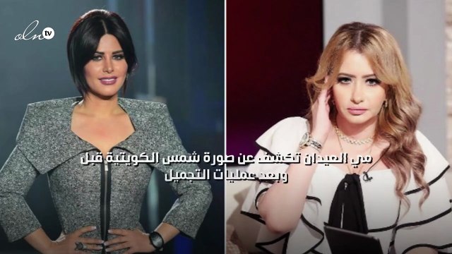 مي العيدان تكشف عن صورة شمس الكويتية قبل وبعد عمليات التجميل
