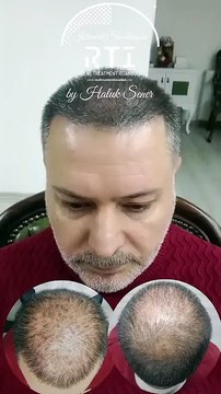 Saç Simülasyonu Saç Çözüm Merkezi Doğru Adres By Haluk Şener Telefon Aşağıda instagram @byhaluksener