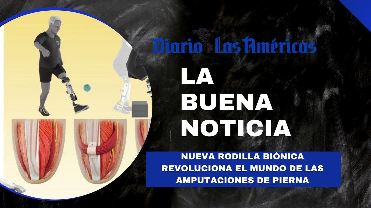 Nueva rodilla biónica revoluciona el mundo de las amputaciones de pierna | La buena noticia