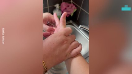 Woman Struggles to Take Wedding Ring off