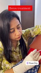 Botox treatment is a quick, non-surgical procedure that softens fine lines and wrinkles on the f