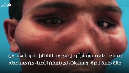 بالصور.. رجل يعيش بوجه أسد لمدة 20 عاماً