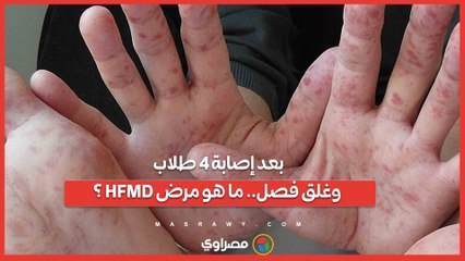 بعد إصابة 4 طلاب وغلق فصل.. ما هو مرض HFMD ؟