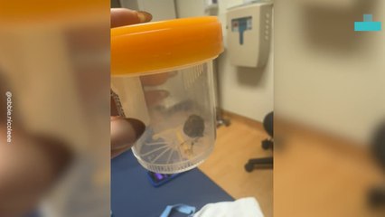 Woman Horrified as Hairball Pulled Out With Her Iud