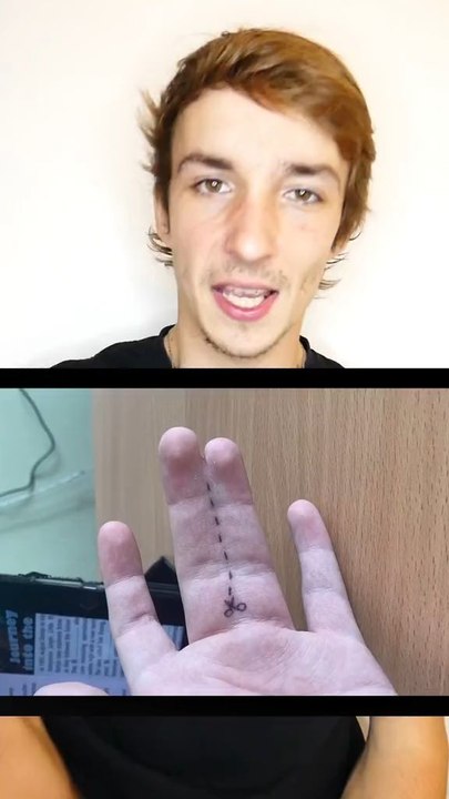 La syndactylie
