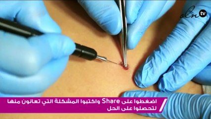 عملية ازالة الشامات مع الدكتور نادر صعب