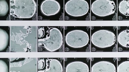 Glioblastoma, le molecole naturali migliorano la chemioterapia