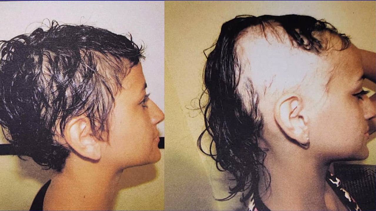 Su Salud: Hablemos de alopecia, causas y tratamientos