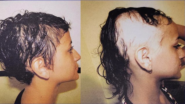 Su Salud: Hablemos de alopecia, causas y tratamientos