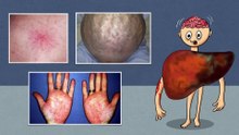 10 Skin signs of Liver Disease Fatty liver