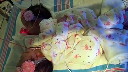 بالفيديو: عملية لم يؤمن الأطباء بنجاحها تنقذ طفلتين من الموت