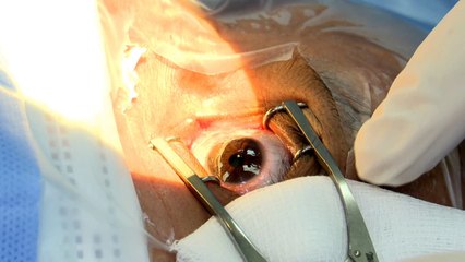 Cataratón en Chitré: fin de semana de operaciones para reducir la mora quirúrgica en oftalmología