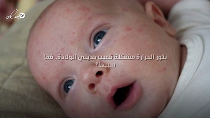 بثور الحرارة مشكلة تصيب حديثي الولادة.. فما سببها؟