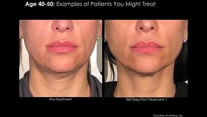 من Clinica Joelle تعرّفي إلى تقنية Ulthera الحديثة لشدّ البشرة بدون جراحة