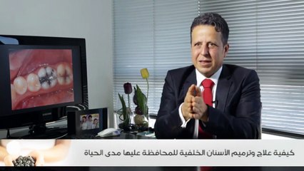 كيفية علاج وترميم الأسنان الخلفية للمحافظة عليها مدى الحياة