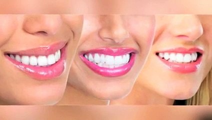 تعرفي على تقنية عدسات الأسنان مع الدكتور مجد ناجي