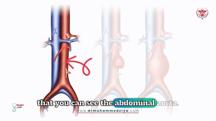 Aortic Aneurysm