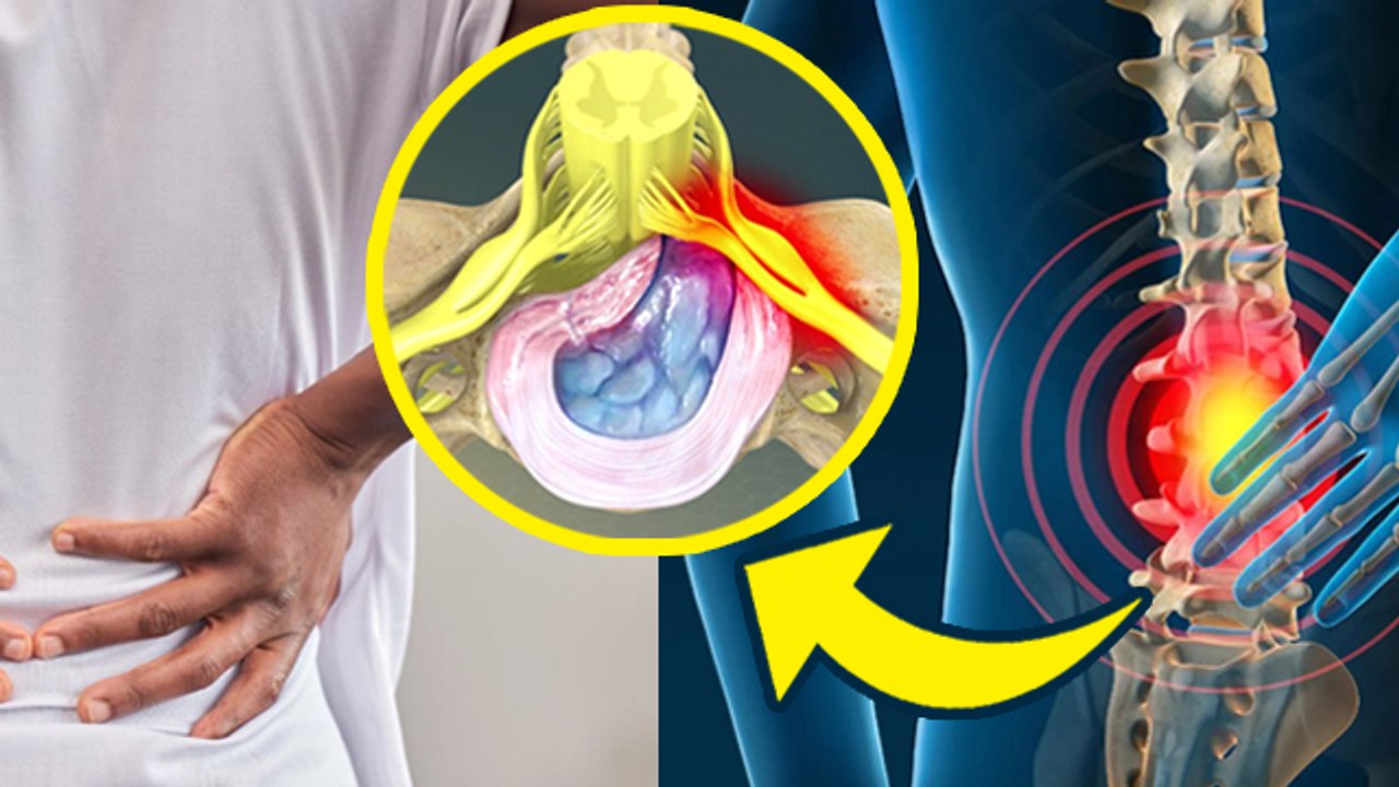 Sciatica Pain Causes: Sciatica Pain Kyu Hota Hai, Symptoms & Treatment | Boldsky