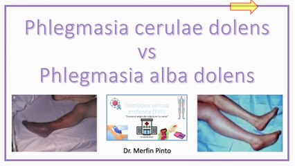 Phlegmasia Cerulae Dolens vs Phlegmasia Alba Dolens #elcuerpoymas #salud #medicina #phelgmasia #Phlegmasiacerulaedolens #Phelgmasiaalbadolens