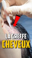 COMMENT ON FAIT UNE GREFFE DE CHEVEUX ?