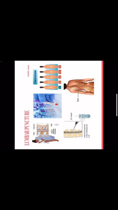 3MT Lumbar Puncture