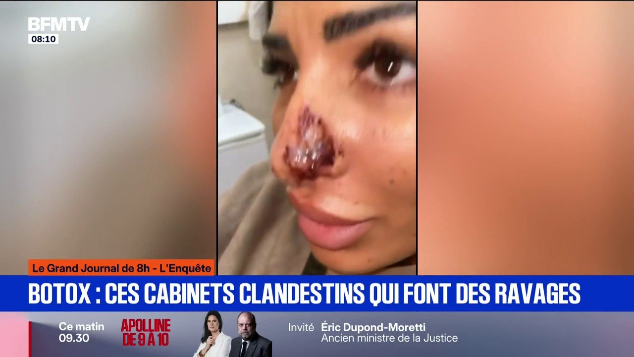 "Le pus coulait": les injections illégales de botox font des ravages