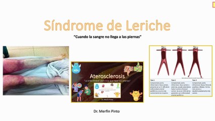 Síndrome de Leriche #elcuerpoymas #salud #medicina #Leriche #SíndromedeLeriche