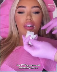 I got my lip filler dissolved and I can't stop crying - even though they were 'botched' before
