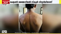 മലപ്പുറം തവനൂരിൽ വിദ്യാർത്ഥിക്ക് ക്രൂരമർദനം; പൊലീസിൽ പരാതി നൽകി കുടുംബം