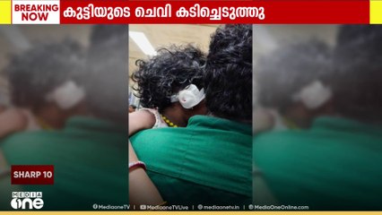 എറണാകുളം  വടക്കൻ പറവൂരിൽ  മൂന്നര വയസുകാരിയുടെ  ചെവി തെരുവ് നായ കടിച്ചെടുത്തു