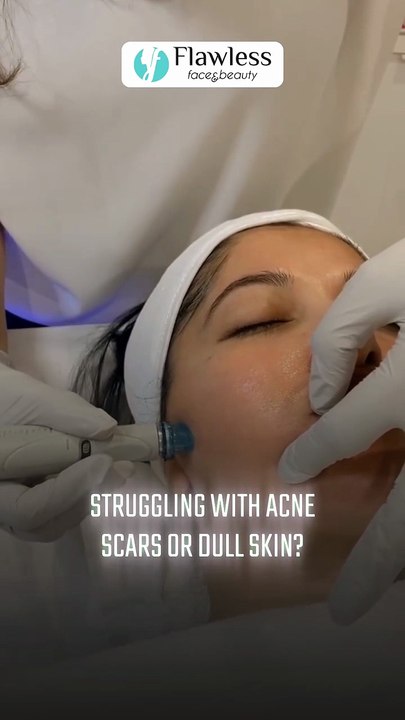 Best Microneedling Treatment at Flawless Beauty!