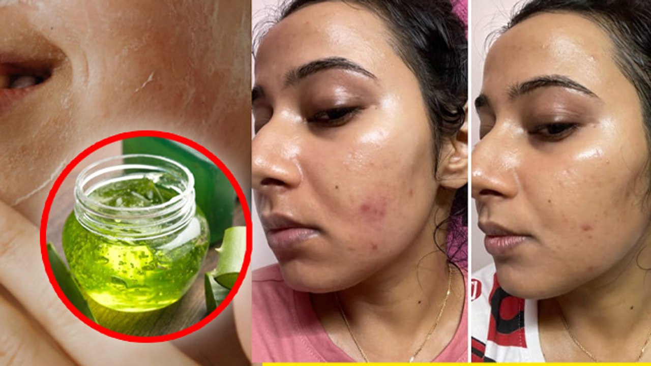 Pimples Kaise Hataye,पिंपल, मुंहासे, दाग-धब्बे...