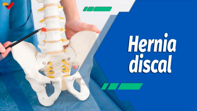 Actitud Saludable | ¿Conoces cuáles son los síntomas para detectar una hernia discal?
