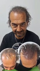 Mehmet Bey Saç Simülasyonu Yaptırdı Eskisi ve Yenisi By Haluk Şener Telefon Aşağıda