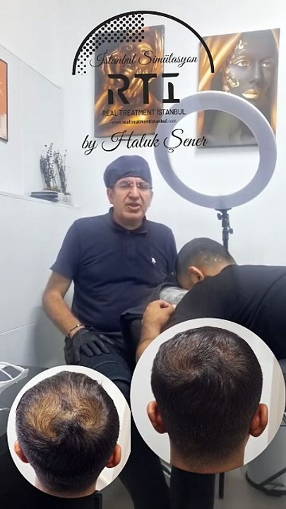 Siirt'ten Danışanımızın Tepe ve Ön Bölgesine Saç Simülasyonu Kapatma Uygulandı By Haluk Şener