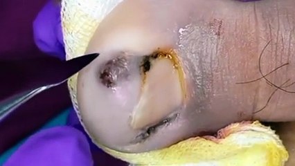 Ingrown Toenail Surgery: Removal and Infected Area Cleanup